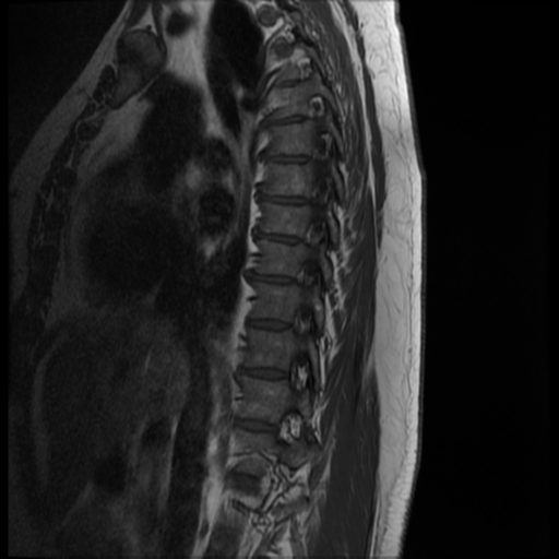 File:Normal cervical and thoracic spine MRI (Radiopaedia 35630-37156 I 10).png