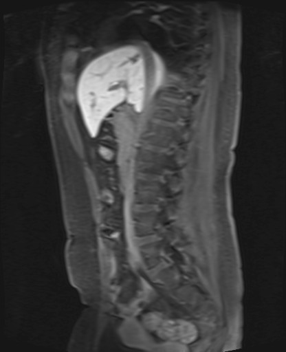 File:Normal hepatobiliary phase liver MRI (Radiopaedia 58968-66230 C 36).jpg