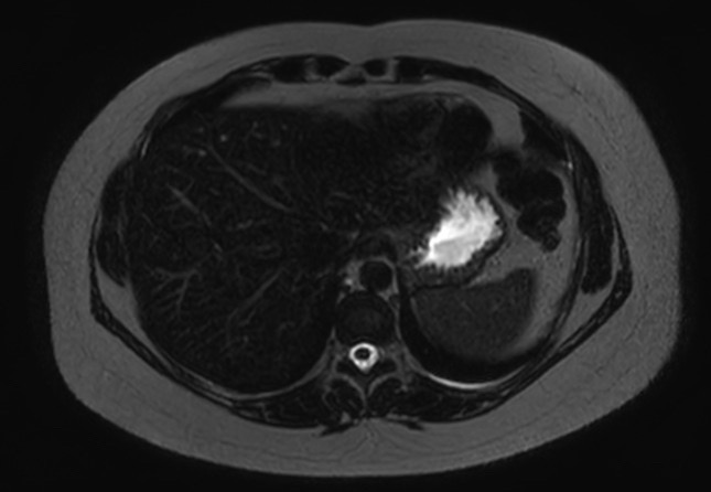 File:Normal liver MRI with Gadolinium (Radiopaedia 58913-66163 E 27).jpg