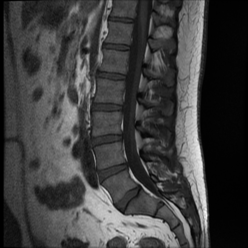 File:Normal lumbar spine MRI (Radiopaedia 35543-37039 Sagittal T1 7).png