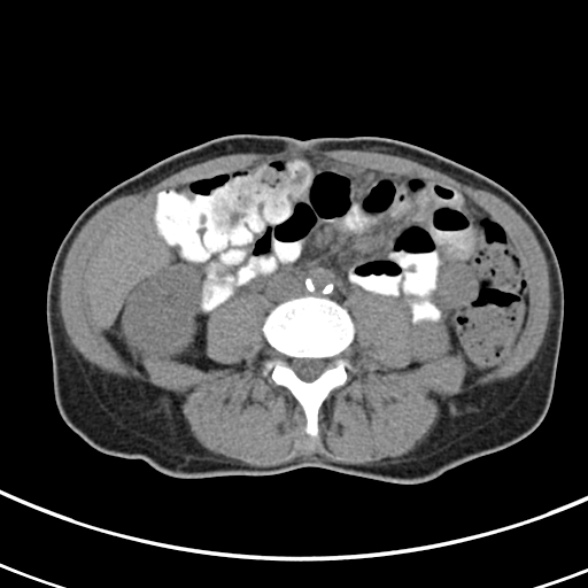 File:Normal multiphase CT liver (Radiopaedia 38026-39996 Axial non-contrast 48).jpg