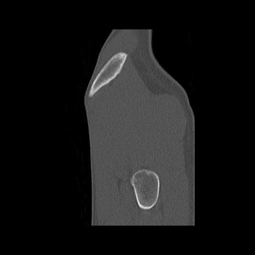 Normal pelvis (Radiopaedia 51473-57238 Sagittal bone window 140).jpg