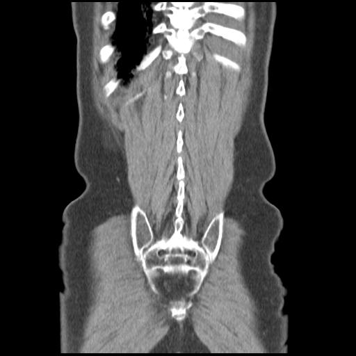 Obstructing renal calculus (Radiopaedia 29517-30016 Coronal non-contrast 47).jpg