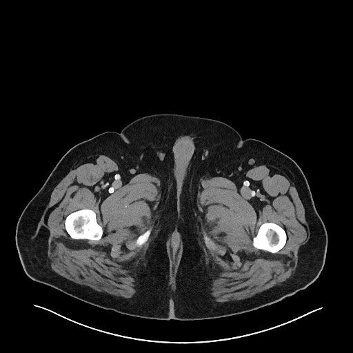 Obstructing sigmoid adenocarcinoma (Radiopaedia 58465-65619 A 179).jpg