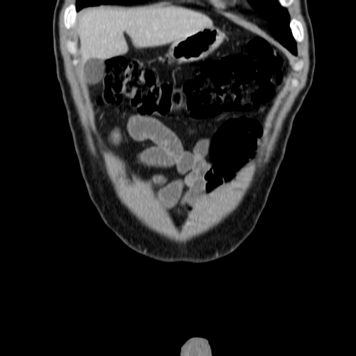 File:Obstructing ureteric calculus (Radiopaedia 18615-18514 C 9).jpg