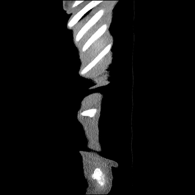 Obturator hernia causing small bowel obstruction (Radiopaedia 65522-74612 C 93).jpg