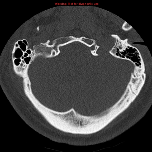 File:Occipital condyle fracture (Radiopaedia 18366-18208 Axial bone window 7).jpg