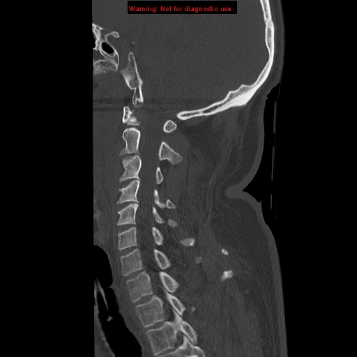 File:Occipital condyle fracture (Radiopaedia 18366-18208 Sagittal bone window 14).jpg