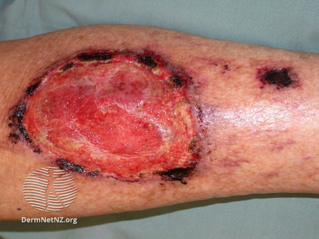 File:Pyoderma gangrenosum (DermNet NZ doctors-emergencies-images-pyodgan4).jpg