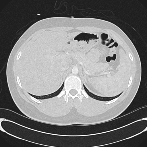 File:'Bovine' aortic arch (Radiopaedia 33554-34637 Axial lung window 64).png
