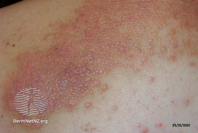 File:(DermNet NZ dermatitis-lichen-simplex-3118).jpg