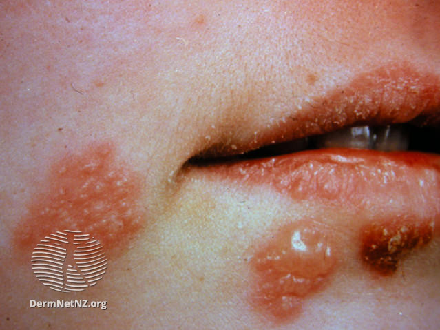 (DermNet NZ herpes-simplex-labialis-24).jpg