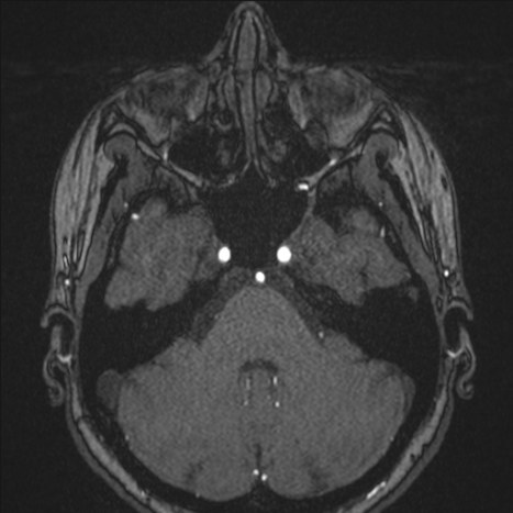 A1 segment hypoplasia (Radiopaedia 83365-97781 Axial TOF MRA 40).jpg
