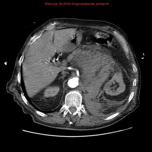 File:Abdominal aortic aneurysm- extremely large, ruptured (Radiopaedia 19882-19921 Axial C+ arterial phase 17).jpg