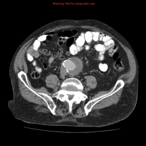 Abdominal aortic aneurysm (Radiopaedia 10122-10660 Axial C+ portal venous phase 53).jpg