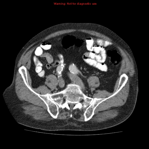 Abdominal aortic aneurysm (Radiopaedia 10122-10660 Axial C+ portal venous phase 57).jpg