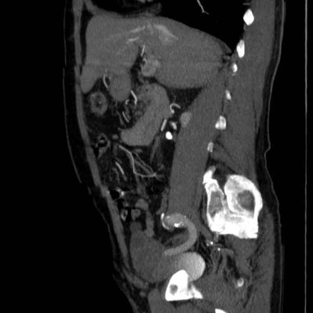 Abdominal aortic aneurysm (Radiopaedia 29248-29660 Sagittal C+ arterial phase 19).jpg