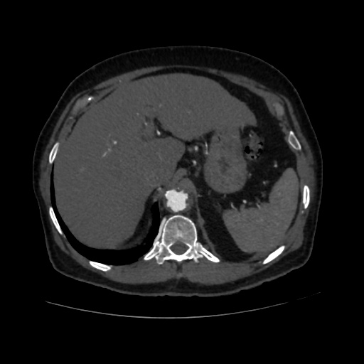 File:Abdominal aortic aneurysm (Radiopaedia 57318-64259 Axial C+ arterial phase 15).jpg