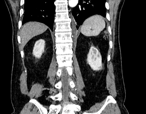 Abdominal aortic aneurysm (Radiopaedia 67117-76452 Coronal C+ arterial phase 82).jpg