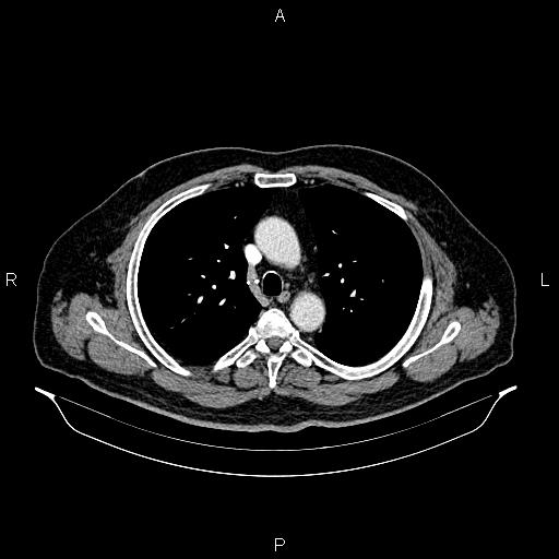 Abdominal aortic aneurysm (Radiopaedia 83094-97462 Axial renal cortical phase 28).jpg