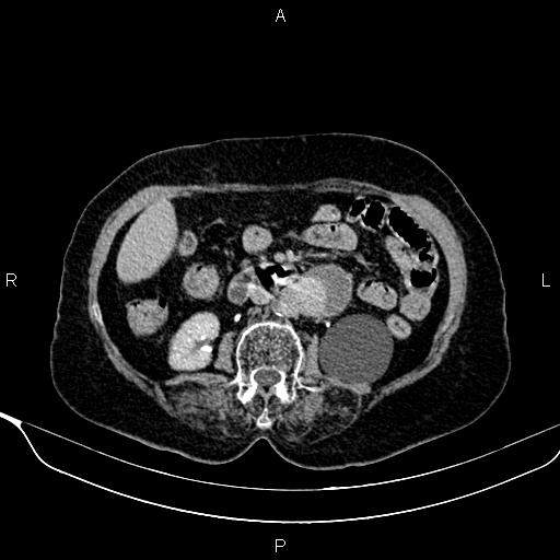 Abdominal aortic aneurysm (Radiopaedia 85063-100606 Axial C+ delayed 49).jpg