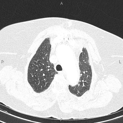 File:Abdominal aortic aneurysm (Radiopaedia 85063-100606 Axial lung window 21).jpg