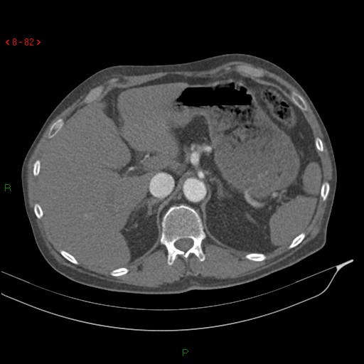 Abdominal aortic aneurysm rupture with aortocaval fistula (Radiopaedia 14897-14841 Axial C+ arterial phase 82).jpg