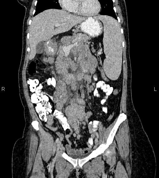 File:Abdominal lymphoma with sandwich sign (Radiopaedia 84378-99704 Coronal C+ portal venous phase 22).jpg