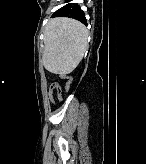 File:Abdominal lymphoma with sandwich sign (Radiopaedia 84378-99704 Sagittal C+ portal venous phase 82).jpg