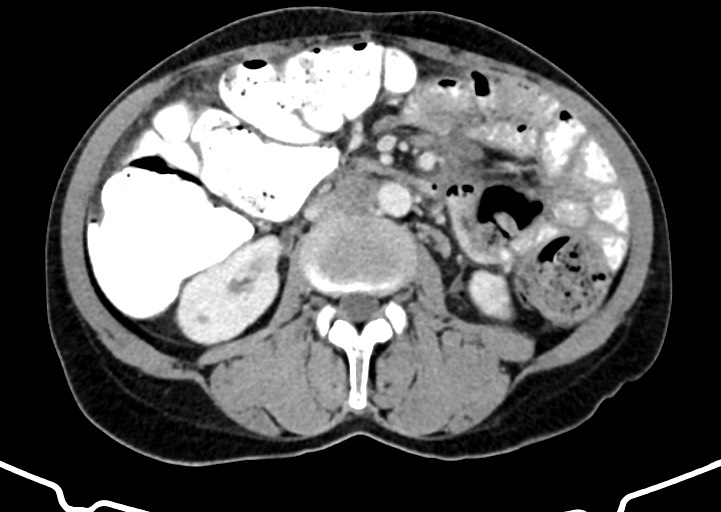 Abdominal wall and retroperitoneal tuberculosis (Radiopaedia 88137-104729 Axial C+ portal venous phase 95).jpg
