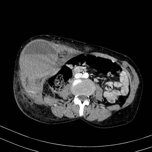 Abdominal wall hematoma with active bleeding (Radiopaedia 83915-99117 Axial renal cortical phase 51).jpg