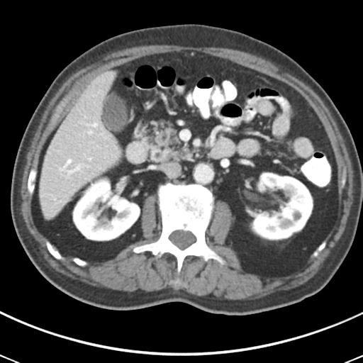 Abdominal wall metastasis from colorectal carcinoma (Radiopaedia 31016-31717 Axial C+ portal venous phase 30).jpg