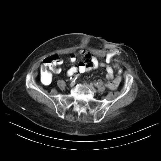 File:Abdominal wall recurrence after colorectal resection for cancer (Radiopaedia 23444-23523 Axial C+ portal venous phase 26).jpg