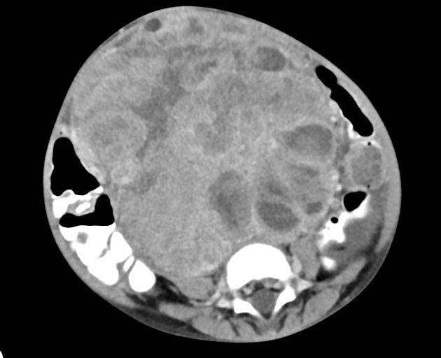 Abdominopelvic rhabdomyosarcoma (Radiopaedia 78356-90984 Axial C+ portal venous phase 110).jpg