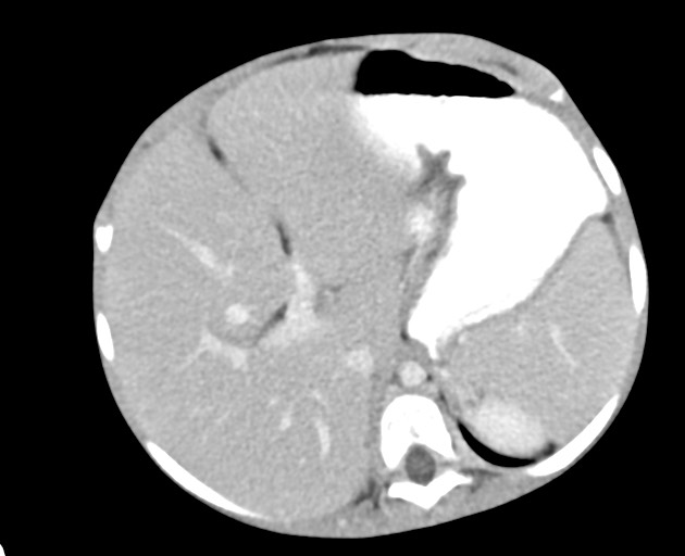 Abdominopelvic rhabdomyosarcoma (Radiopaedia 78356-90984 Axial C+ portal venous phase 53).jpg