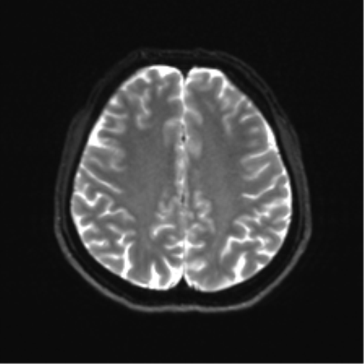 Abducens nerve palsy (Radiopaedia 51069-56648 Axial DWI 19).png