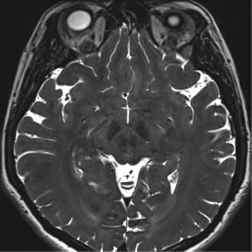 Abducens nerve palsy (Radiopaedia 51069-56648 Axial T2 fat sat 80).png