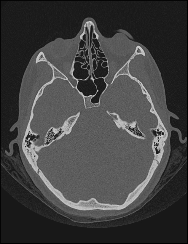 Aberrant right internal carotid artery (Radiopaedia 65191-74198 Axial non-contrast 57).jpg