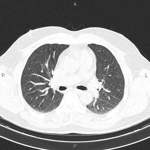 File:Aberrant right subclavian artery (Radiopaedia 87093-103354 Axial lung window 48).jpg