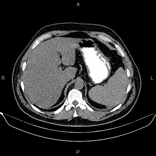 Aberrant right subclavian artery (Radiopaedia 87093-103354 Axial non-contrast 109).jpg