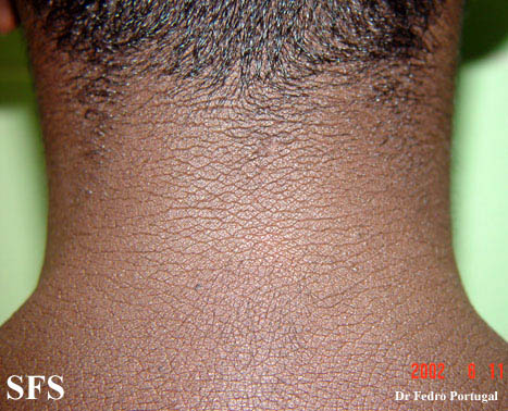 File:Acanthosis Nigricans-Benign (Dermatology Atlas 7).jpg