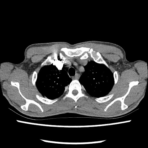 Accessory left horizontal fissure with lingular pneumonia (Radiopaedia 53763-59843 Axial C+ CTPA 19).jpg