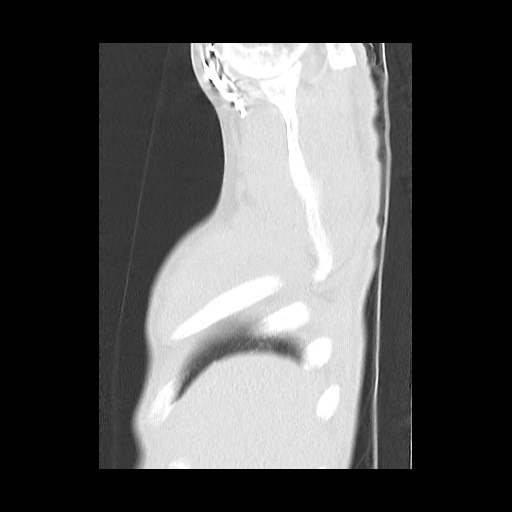 Accessory left horizontal fissure with lingular pneumonia (Radiopaedia 53763-59843 Sagittal lung window 8).jpg