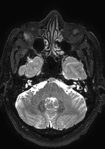 Accessory middle cerebral artery (Radiopaedia 73114-83828 Axial T2 167).jpg