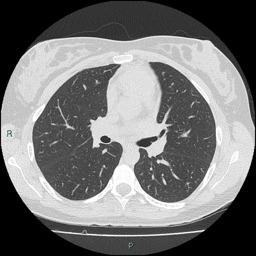 Accidental foreign body aspiration (seamstress needle) (Radiopaedia 77740-89983 Axial lung window 30).jpg