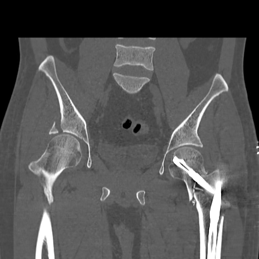 Acetabular and ilial fractures (Radiopaedia 59084-66378 Coronal bone window 27).jpg