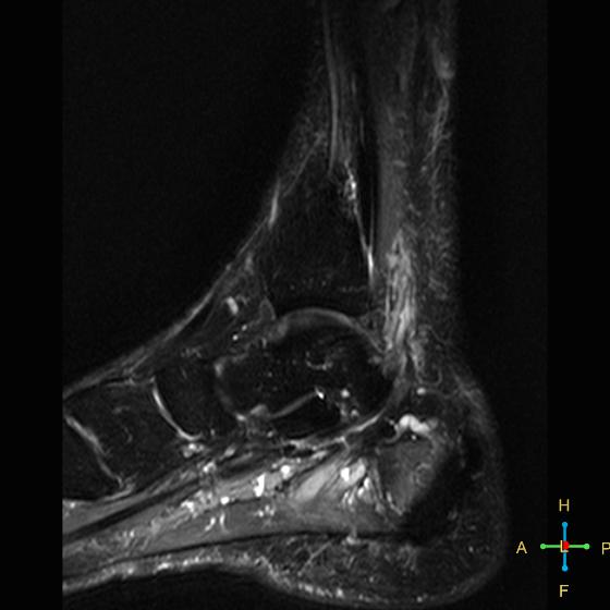 File:Achilles tendon complete tear (Radiopaedia 22834-22854 Sagittal STIR 13).jpg