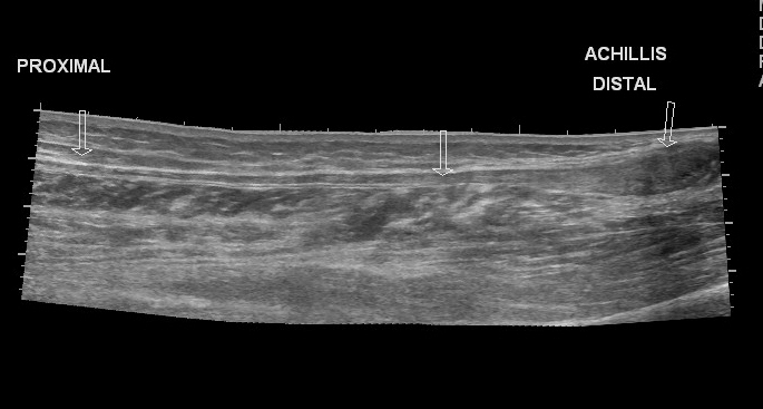 File:Achilles tendon tear (Radiopaedia 18551-18421 D 1).jpg