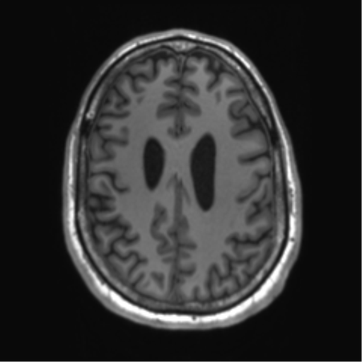 File:Achondroplasia (Radiopaedia 65109-74105 Axial T1 15).png