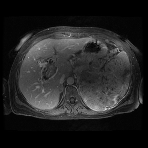 Acinar cell carcinoma of the pancreas (Radiopaedia 75442-86668 Axial T1 C+ fat sat 95).jpg